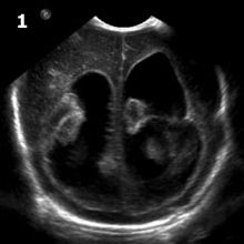 Coronal Image Head Ultrasound Hydrocephalus Case Study