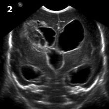 Coronal Image Head Ultrasound Hydrocephalus Case Study