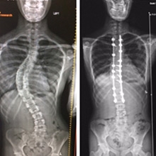 Courtney Scoliosis X-rays