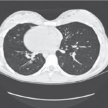 CT image of chest in axial plane
