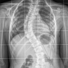 early onset scoliosis on xray