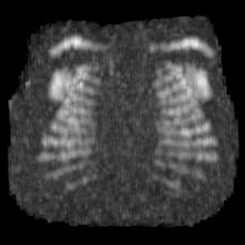 absence of vertebral bodies CT scan