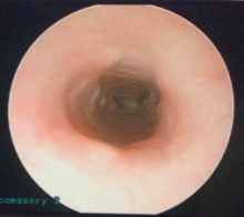 Post-reconstruction view of airway during MLB showing widely patent airway.
