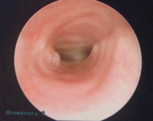 Post-reconstruction view of airway during MLB showing widely patent airway.