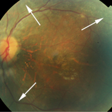 fundus image of left eye