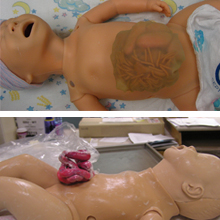 gastroschisis manikin examples