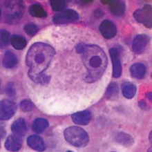 Hodgkin Lymphoma cell