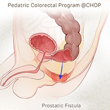 Illustration of rectum with prostatic fistula