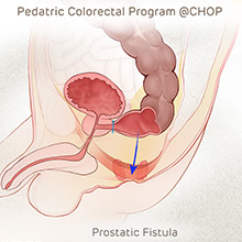 Illustration of rectum with prostatic fistula