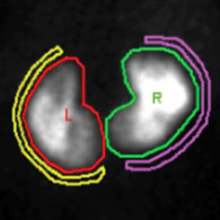 Image of DMSA showing scarring