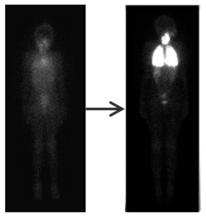 Larotrectinib in Child with TRK Fusion Thyroid Cancer