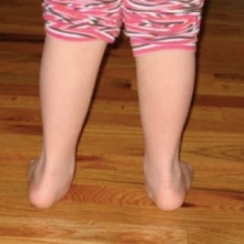 Child's foot with a pronated left hind foot