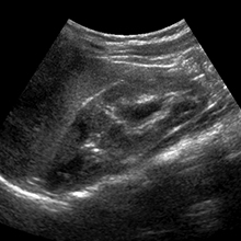 Left kidney showing a duplicated collecting system