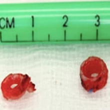 Long Segment Tracheal Stenosis Figure 6