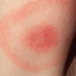 Lyme disease rash