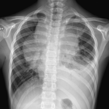 chest xray with lymphoma