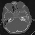 mastoiditis figure 1