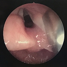 Microlaryngoscopy and bronchoscopy image showing cleft