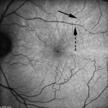 hypoautofluorescent areas of mother's left eye