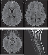 MRI of brain and spine