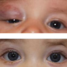 Before and after images of Phace syndrome