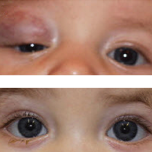 Before and after images of Phace syndrome