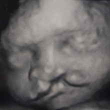 List of 20+ what is a cleft lip 2 Cleft Lip and Palate | Children's Hospital of Philadelphia