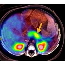 3-D PET image shows focal lesion in the pancreatic body (arrow).