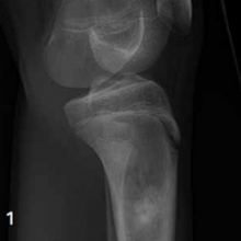 Side X-ray of the tibia
