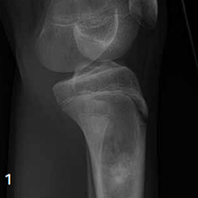 Side X-ray of the tibia