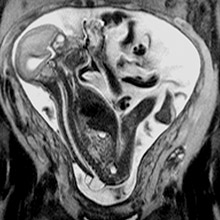 fetal MRI spina bifida