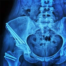 Lauren's X Ray