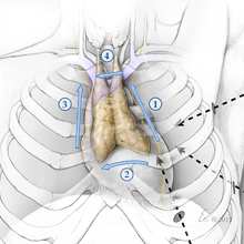 internal view of thymectomy