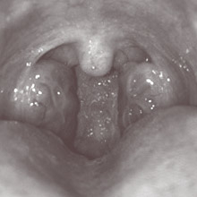 tonsils