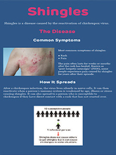 Shingles Vaccine infographic