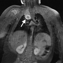 When Anisocoria Signals A Bigger Problem - Figure 2