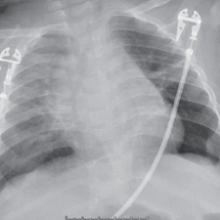 Chest X-ray concerning for pneumonia