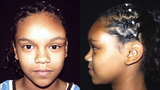 Patient with fibrous dysplasia involving the forehead and left upper orbit