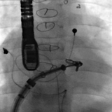 chop-researchers-successfully-employ-new-method-treating-pediatric-patients-common-heart-valve