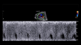 Spectral doppler signal