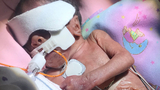 premature baby