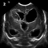 Coronal Image Head Ultrasound Hydrocephalus Case Study
