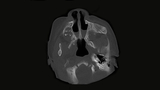 choanal atresia CT scan