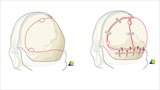 Demonstration of the bony cuts of a posterior vault remodeling