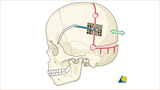 Demonstration of the bony cuts and placement of posterior vault distractors