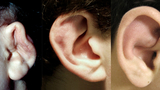 Cauliflower Ears Image