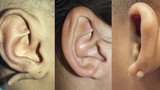 Earlobe Deformities Image