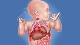 Illustration of ECMO example