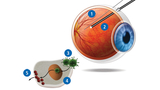 Diagram illustrating gene therapy for inherited blindness