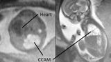 fetal mri at 23 weeks